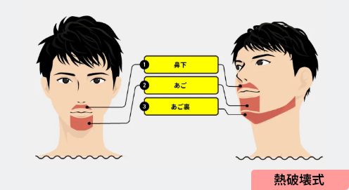 イラスト：ヒゲ脱毛（3部位）